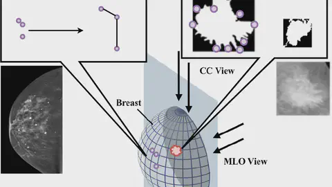 Breast Cancer Detection via Multimodal Fusion with GCN