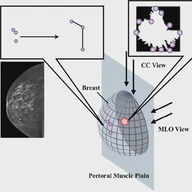 Breast Cancer Detection via Multimodal Fusion with GCN