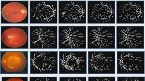 Retinal Image Analysis & Local Haar Pattern (LHP) Descriptor