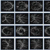Retinal Image Analysis & Local Haar Pattern (LHP) Descriptor