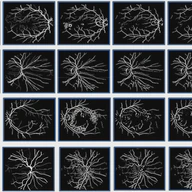 Retinal Image Analysis & Local Haar Pattern (LHP) Descriptor