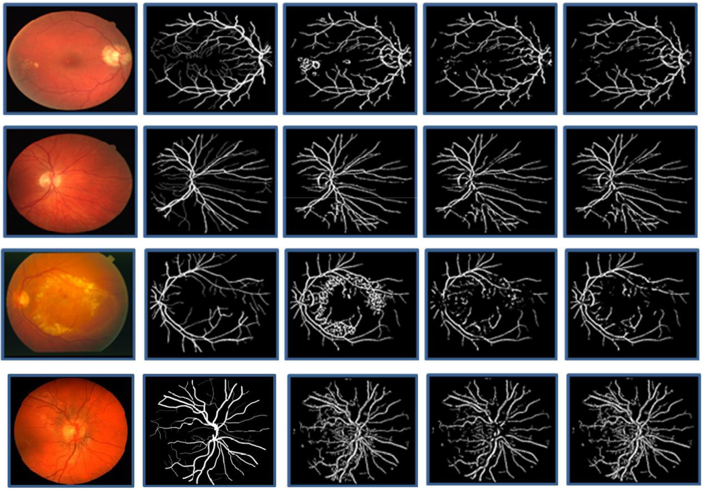 An innovate approach for retinal blood vessel segmentation using ...