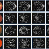 An innovate approach for retinal blood vessel segmentation using mixture of supervised and unsupervised methods