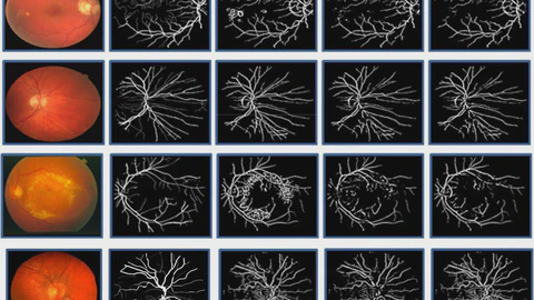 An innovate approach for retinal blood vessel segmentation using mixture of supervised and unsupervised methods
