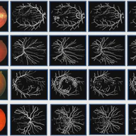An innovate approach for retinal blood vessel segmentation using mixture of supervised and unsupervised methods
